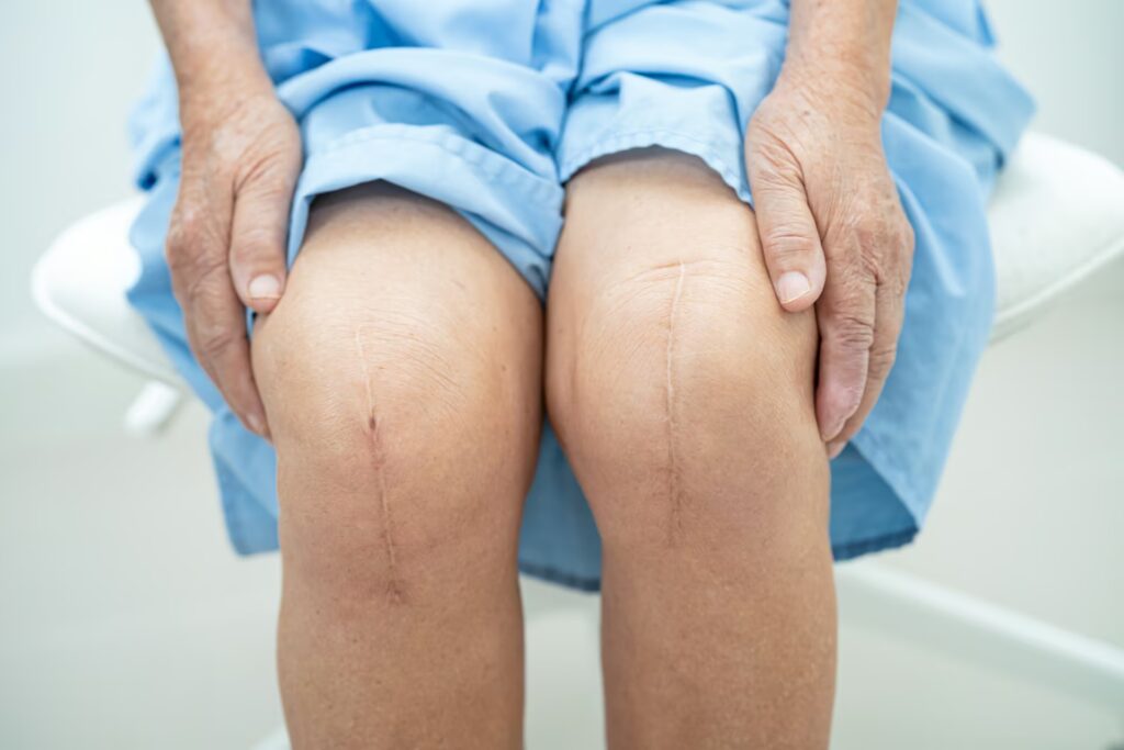 Joint Replacement 3 asian elderly woman patient show her scars surgica 2025 02 24 11 30 40 utc 1