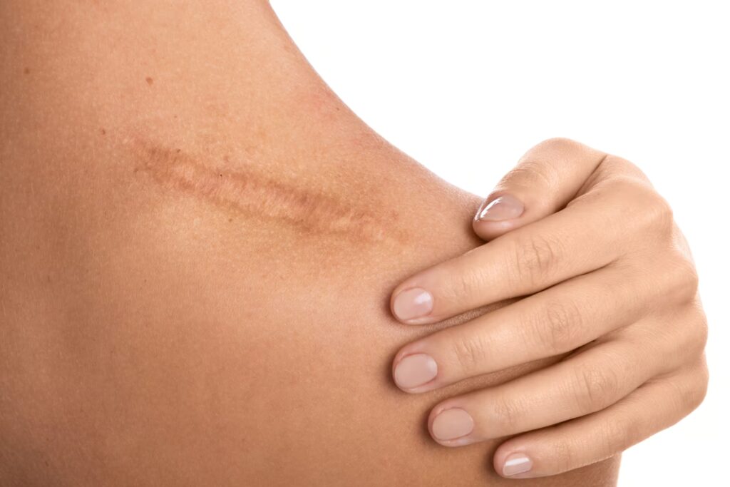 Scar Therapy 5 woman with a scar on her shoulder 2024 10 15 04 49 04 utc 1